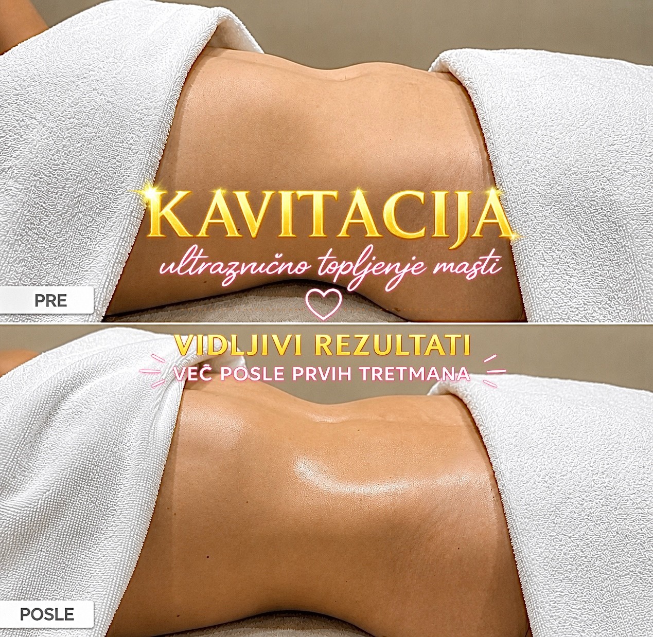 Ultrazvučna kavitacija pre i posle tretmana